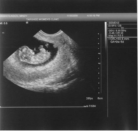 Little Weebl's first ultrasound, picture 2