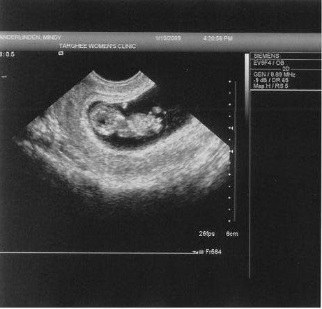 Little Weebl's first ultrasound, picture 3